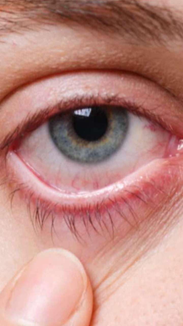 आंखों में दिखने लगते हैं डायबिटीज के ये लक्षण