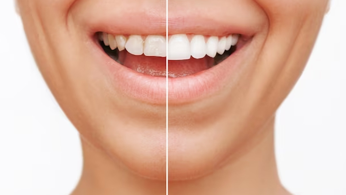 Myth Buster: Popular Teeth Whitening Myths Debunked By Dental Expert