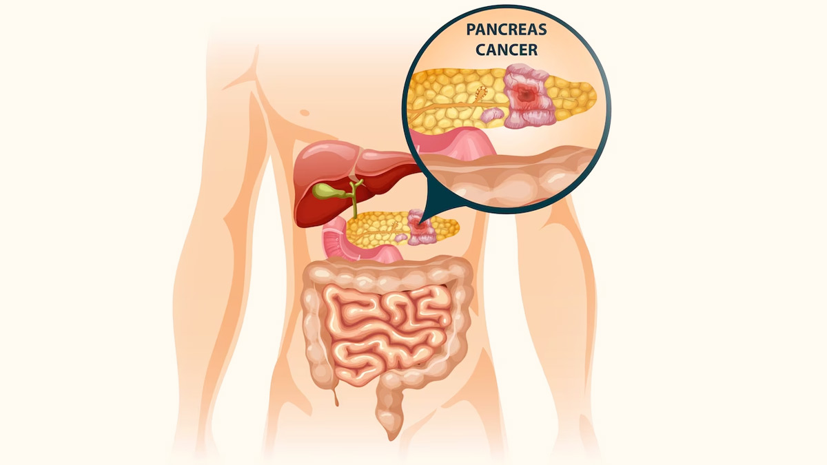Pancreatic Cancer Signs: கணைய புற்றுநோயின் எச்சரிக்கை அறிகுறிகள்!